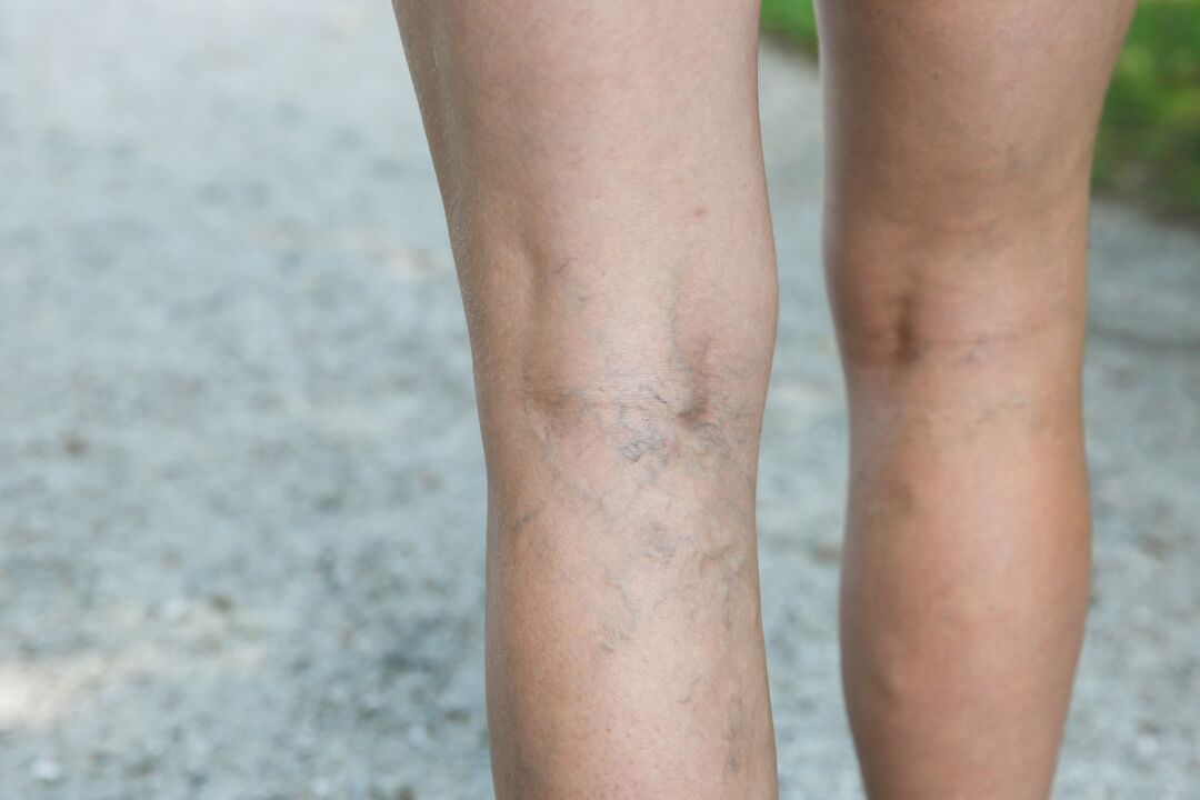 For varicose veins, the exercise program should be discussed with your doctor. 